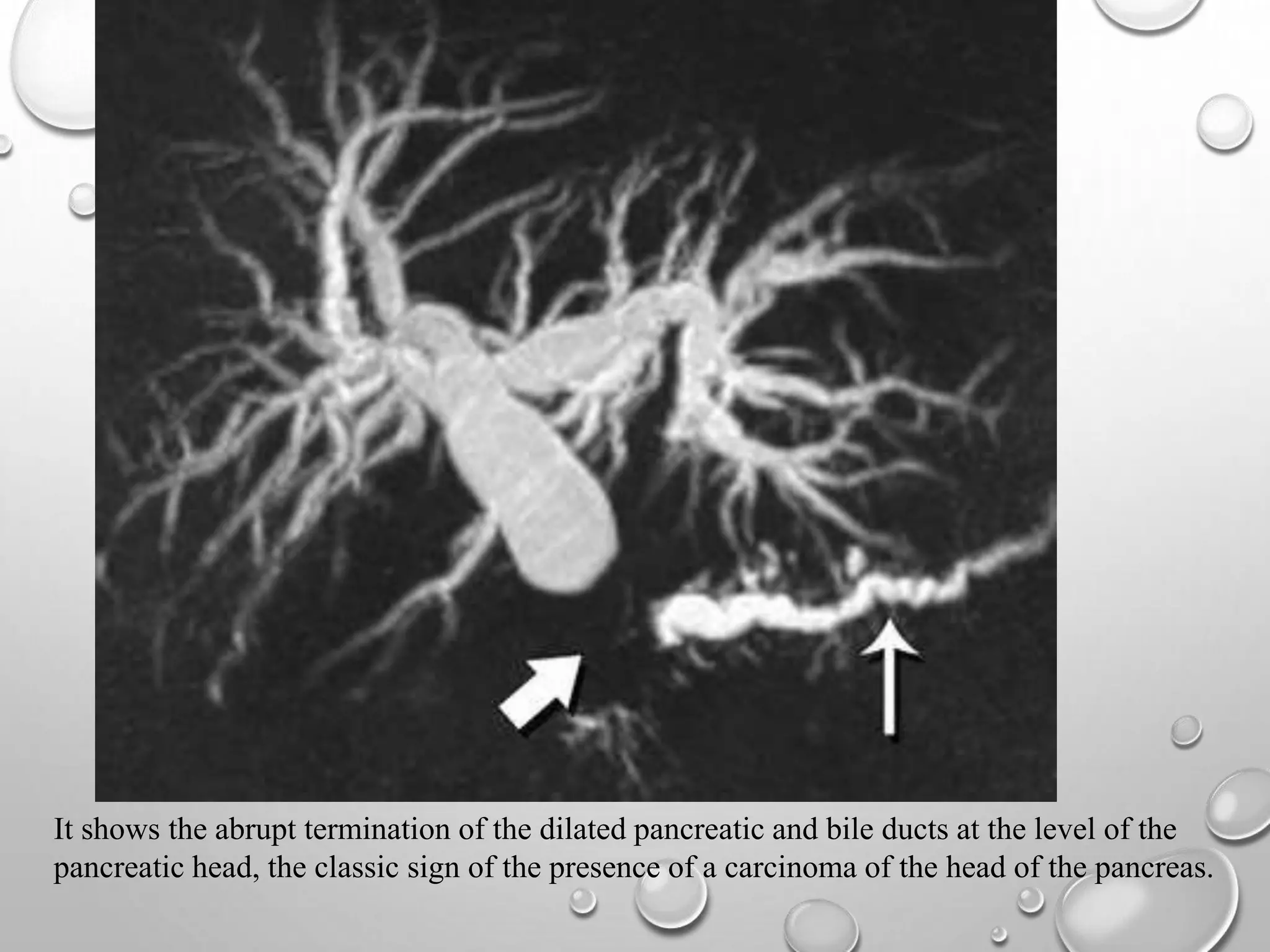 It shows the abrupt termination of the dilated pancreatic and bile ducts at the level of the
pancreatic head, the classic sign of the presence of a carcinoma of the head of the pancreas.
 