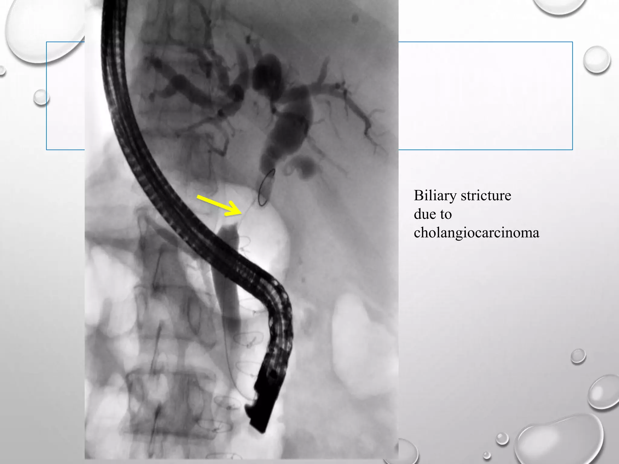 Biliary stricture
due to
cholangiocarcinoma
 
