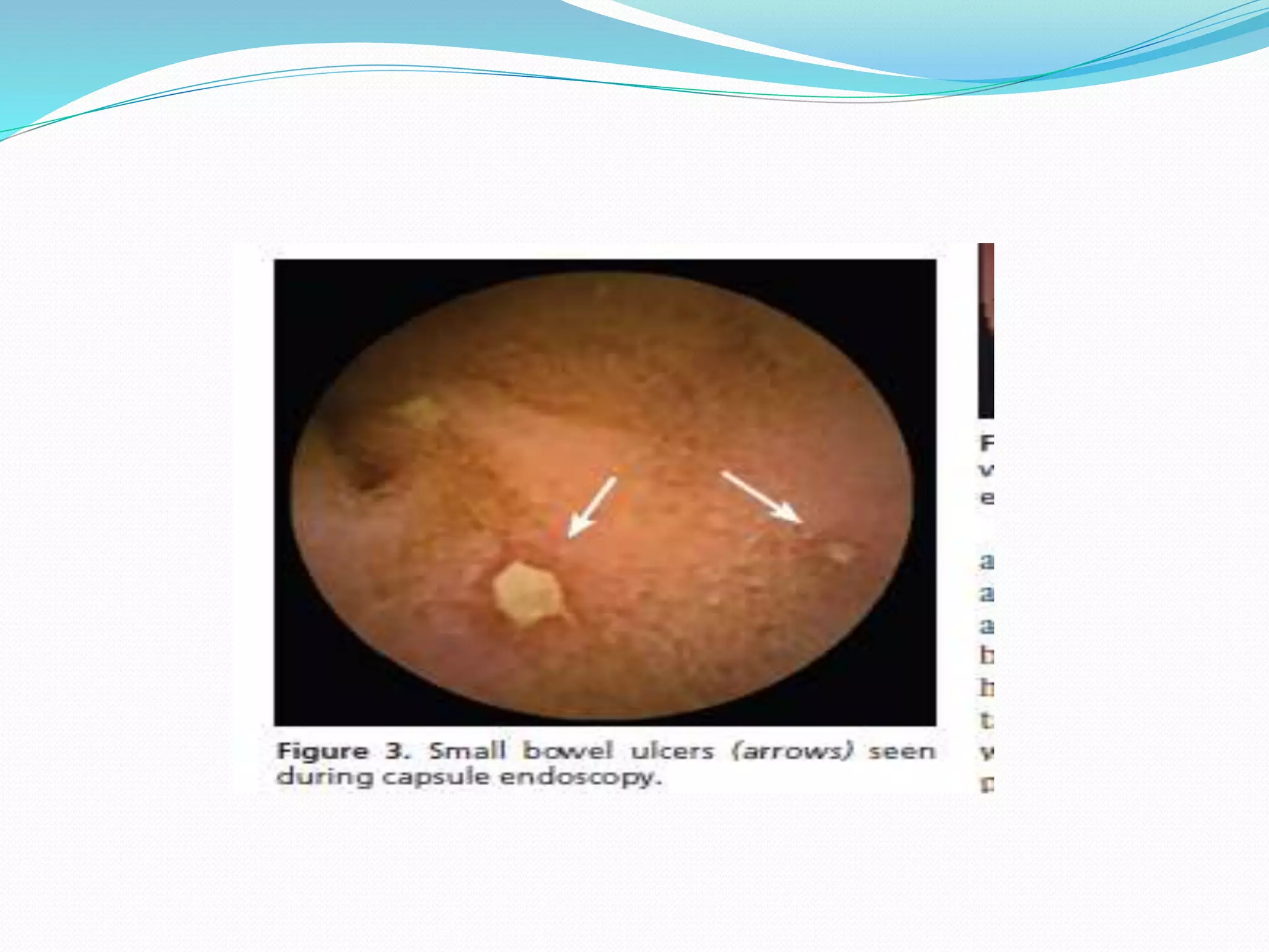 Picture of Approach to occult bleeding | PPTX