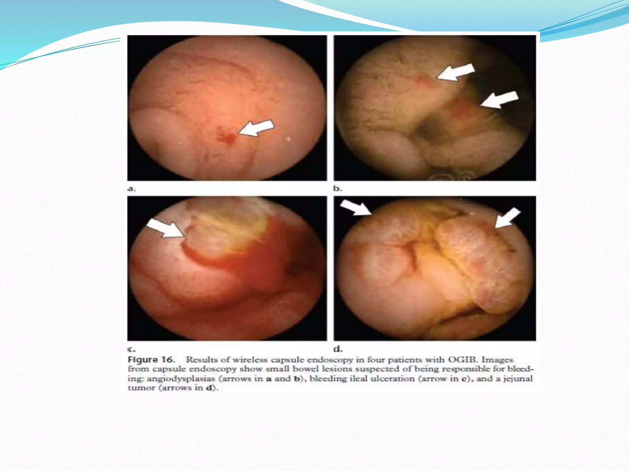 View of Approach to occult bleeding | PPTX