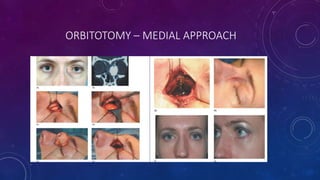ORBITOTOMY – MEDIAL APPROACH
 