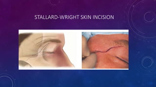 STALLARD-WRIGHT SKIN INCISION
 