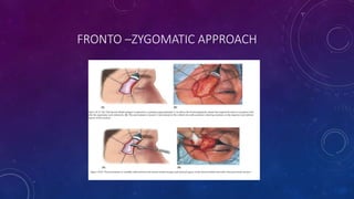 FRONTO –ZYGOMATIC APPROACH
 