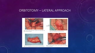 ORBITOTOMY – LATERAL APPROACH
 