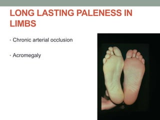 LONG LASTING PALENESS IN
LIMBS
• Chronic arterial occlusion
• Acromegaly
 