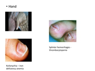 • Hand
Koilonychia – iron
deficiency anemia
Splinter hemorrhages -
thrombocytopenia
 