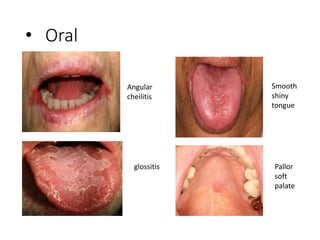 • Oral
Angular
cheilitis
glossitis
Smooth
shiny
tongue
Pallor
soft
palate
 