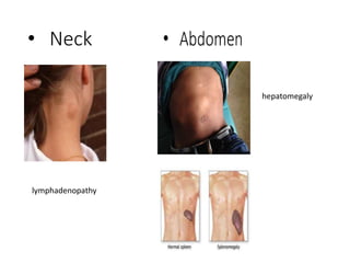 • Neck
lymphadenopathy
hepatomegaly
 