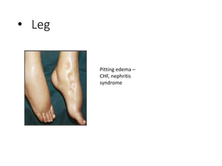 • Leg
Pitting edema –
CHF, nephritis
syndrome
 
