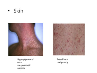 • Skin
Hyperpigmentati
on –
megaloblastic
anemia
Petechiae -
malignancy
 