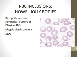 RBC INCLUSIONS:
HOWEL JOLLY BODIES
• Basophilic nuclear
remnants (clusters of
DNA) in RBCs
• Megaloblastic anemia
• MDS
24
 