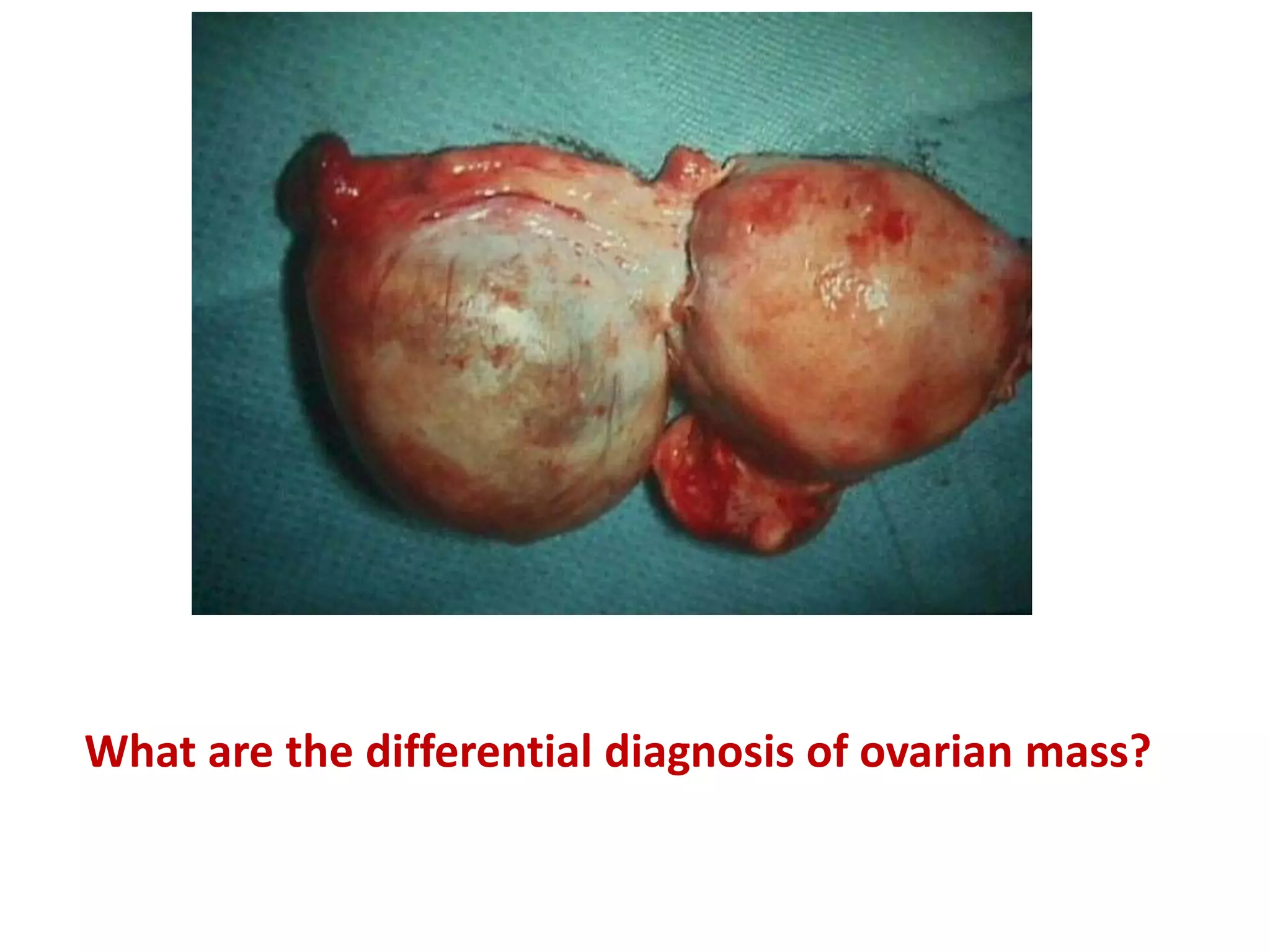 What are the differential diagnosis of ovarian mass?
 