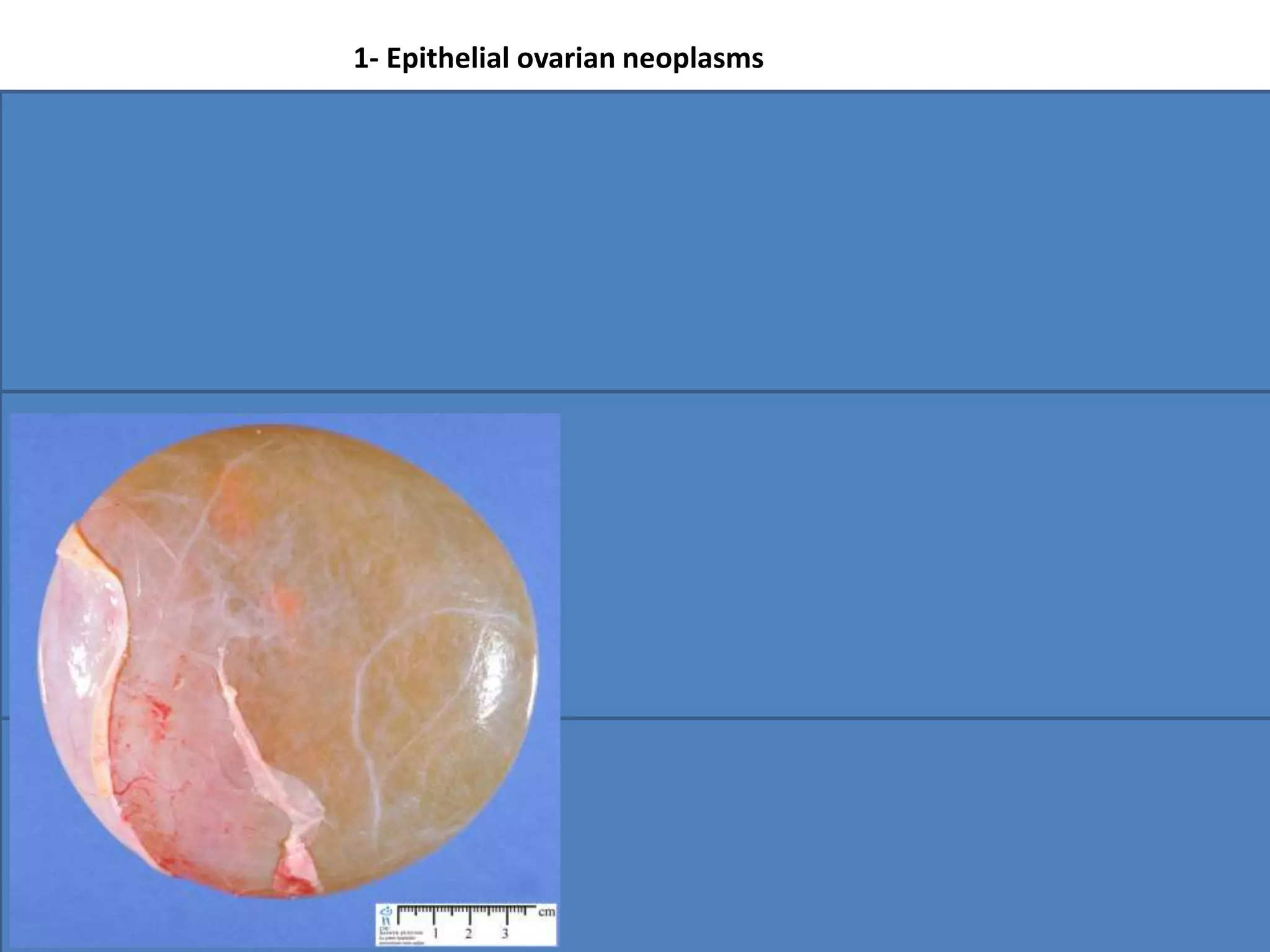 US/CytologyPRESENTATIONDESCRIPTIONTYPE
•Often multilocular
•Histologicaly contain
Psammoma bodies
(calcified concentric
concretions)
10% bilateral
• most common is serous
cystadenoma
•70 % benign
•5-10%borderline
malignant
•20% to 25% are malignant
Serous
•Resembles
endocervical
epithelium
•Often multilocular
•Often associated with
a mucocele of the
appendix
Huge size,
Often filling entire
pelvis
•may be
complicated by
pseudomyxoma
peritonei
•85% benign
•20% of epithelial tumors
Mucinous
•Has a large fibrotic
component that
encases epithelioid
cells that resemble
transitional cells of the
bladder.
•a small, smooth
solid ovarian
neoplasm.
•usually benign
•33% are associated with
mucinous epithelial
elements.
Brenner
1- Epithelial ovarian neoplasms
 