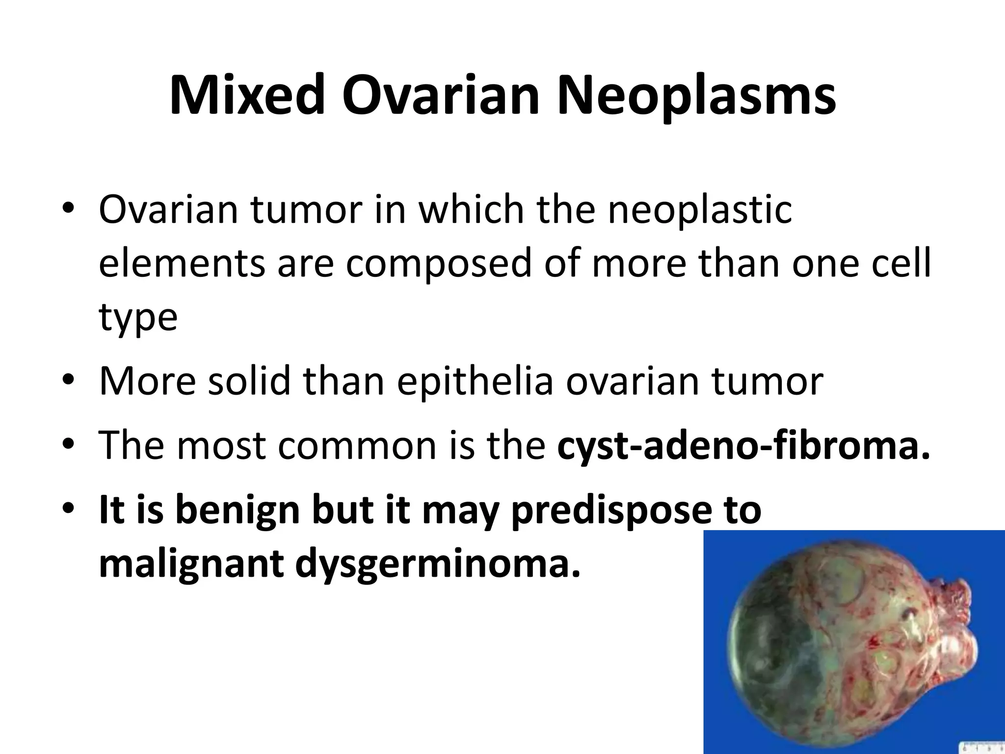 Mixed Ovarian Neoplasms
• Ovarian tumor in which the neoplastic
elements are composed of more than one cell
type
• More solid than epithelia ovarian tumor
• The most common is the cyst-adeno-fibroma.
• It is benign but it may predispose to
malignant dysgerminoma.
 