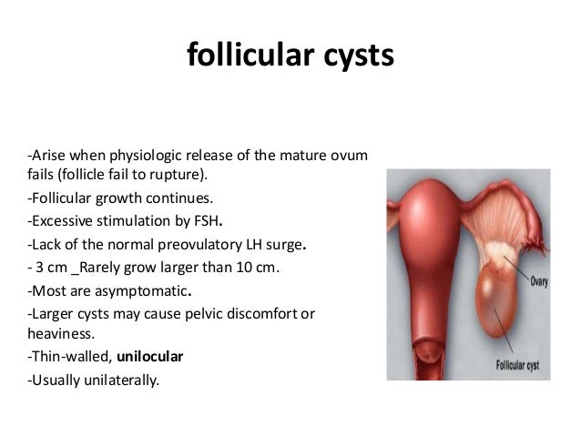 Ruptured Hemorrhagic Corpus Luteum Cysts Can Result In A Hemoperitoneum Requiring Surgery 31 Ruptured Hemorrhagic Corpus Luteum Cysts Can Result In A Hemoperitoneum Requiring Surgery 31