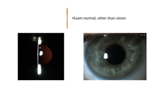 •Exam normal, other than vision
 