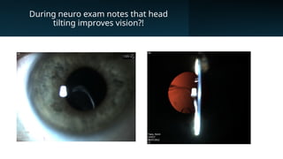 During neuro exam notes that head
tilting improves vision?!
 