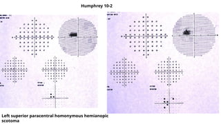 Humphrey 10-2
Left superior paracentral homonymous hemianopic
scotoma
 