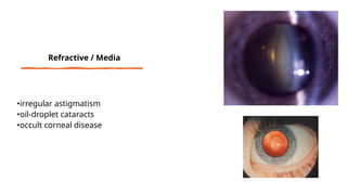 •irregular astigmatism
•oil-droplet cataracts
•occult corneal disease
Refractive / Media
 