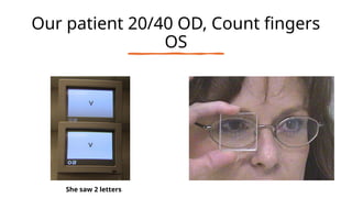 Our patient 20/40 OD, Count fingers
OS
She saw 2 letters
 