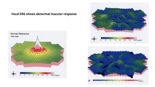 Focal ERG shows abnormal macular response
 