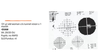 •31-yr-old woman c/o tunnel vision x 1
month
•EXAM
VA: 20/20 OU
Pupils: no RAPD
SLE/Fundus: nl
 