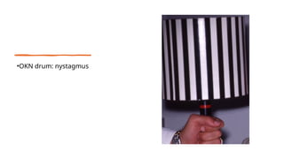 •OKN drum: nystagmus
 