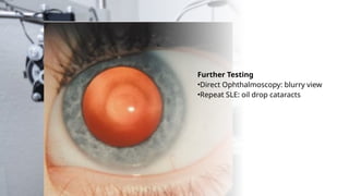 Further Testing
•Direct Ophthalmoscopy: blurry view
•Repeat SLE: oil drop cataracts
 