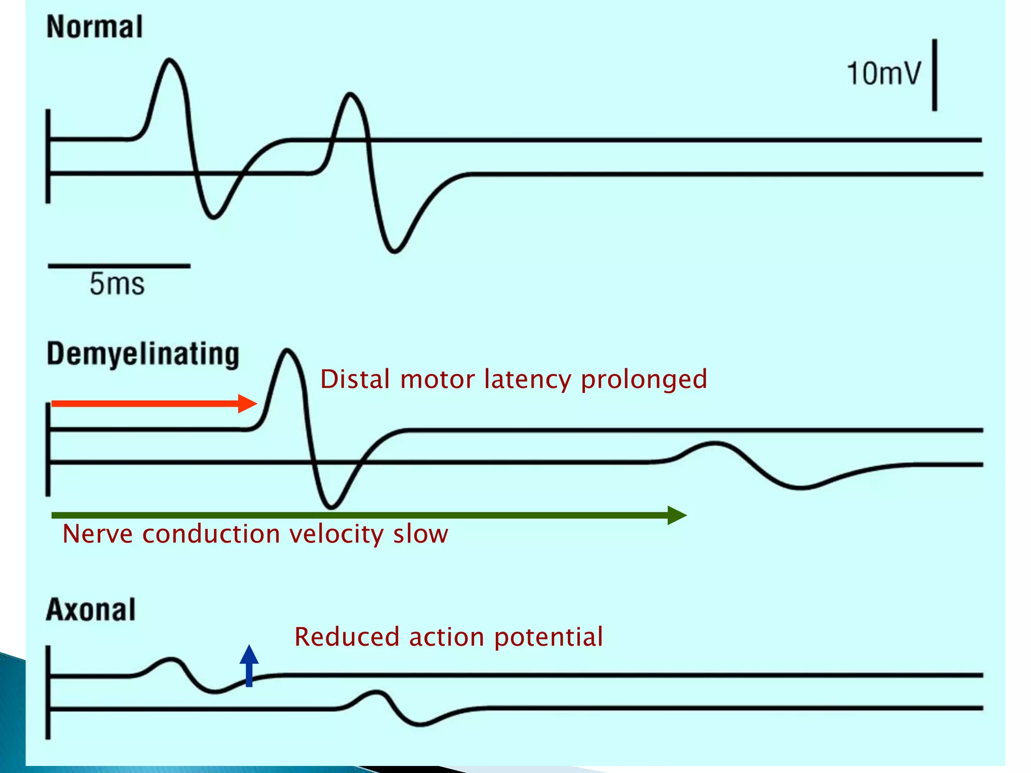 Distal motor latency prolonged 
Nerve conduction velocity slow 
Reduced action potential 
 