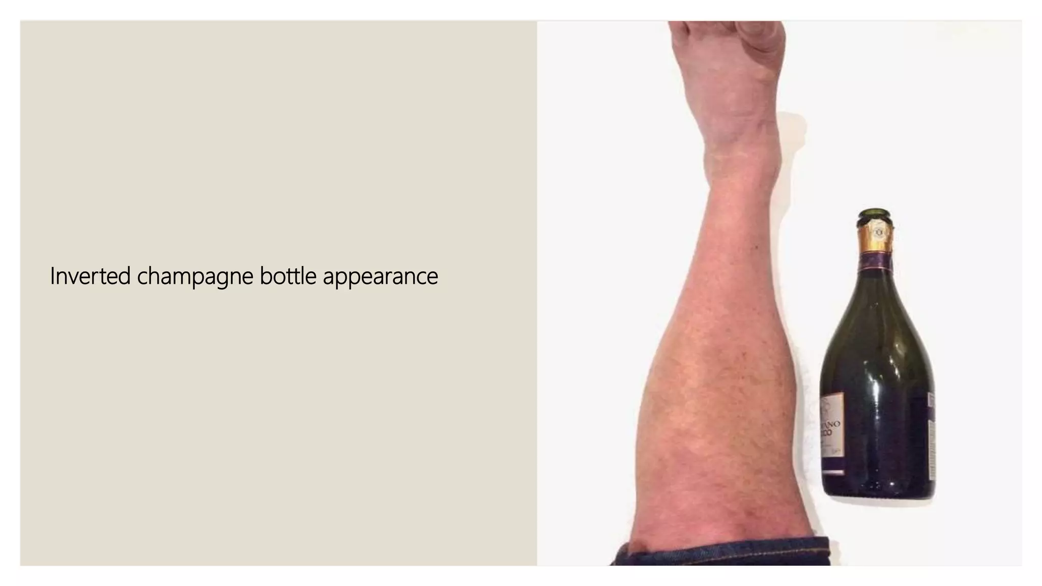 Inverted champagne bottle appearance
 