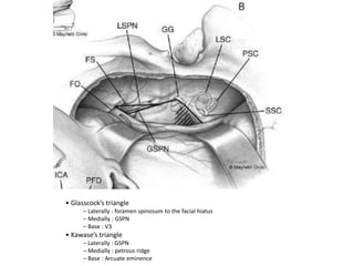 Petrous Ridge Positioning Chart Approach to petroclival meningioma | PPTX