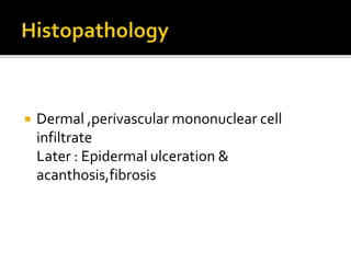 Dermal ,perivascular mononuclear cell
infiltrate
Later : Epidermal ulceration &
acanthosis,fibrosis
 