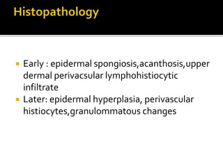  Early : epidermal spongiosis,acanthosis,upper
dermal perivacsular lymphohistiocytic
infiltrate
 Later: epidermal hyperplasia, perivascular
histiocytes,granulommatous changes
 