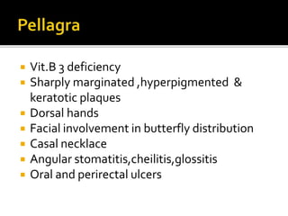  Vit.B 3 deficiency
 Sharply marginated ,hyperpigmented &
keratotic plaques
 Dorsal hands
 Facial involvement in butterfly distribution
 Casal necklace
 Angular stomatitis,cheilitis,glossitis
 Oral and perirectal ulcers
 