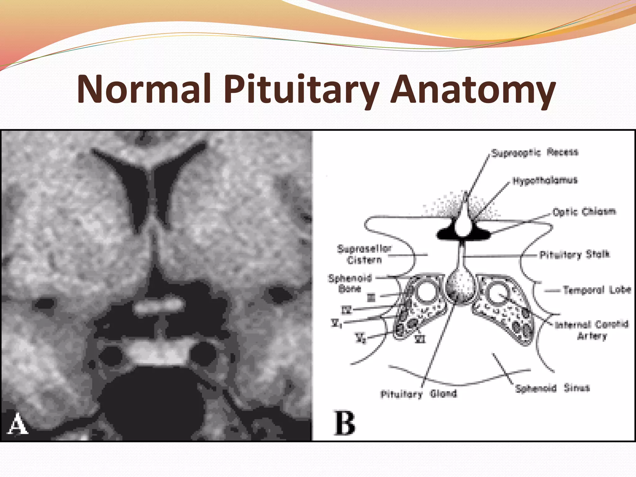 Normal Pituitary Anatomy
Modified from Lechan RM. Neuroendocrinology of Pituitary Hormone Regulation. Endocrinology and Metabolism Clinics 16:475-501, 1987
 