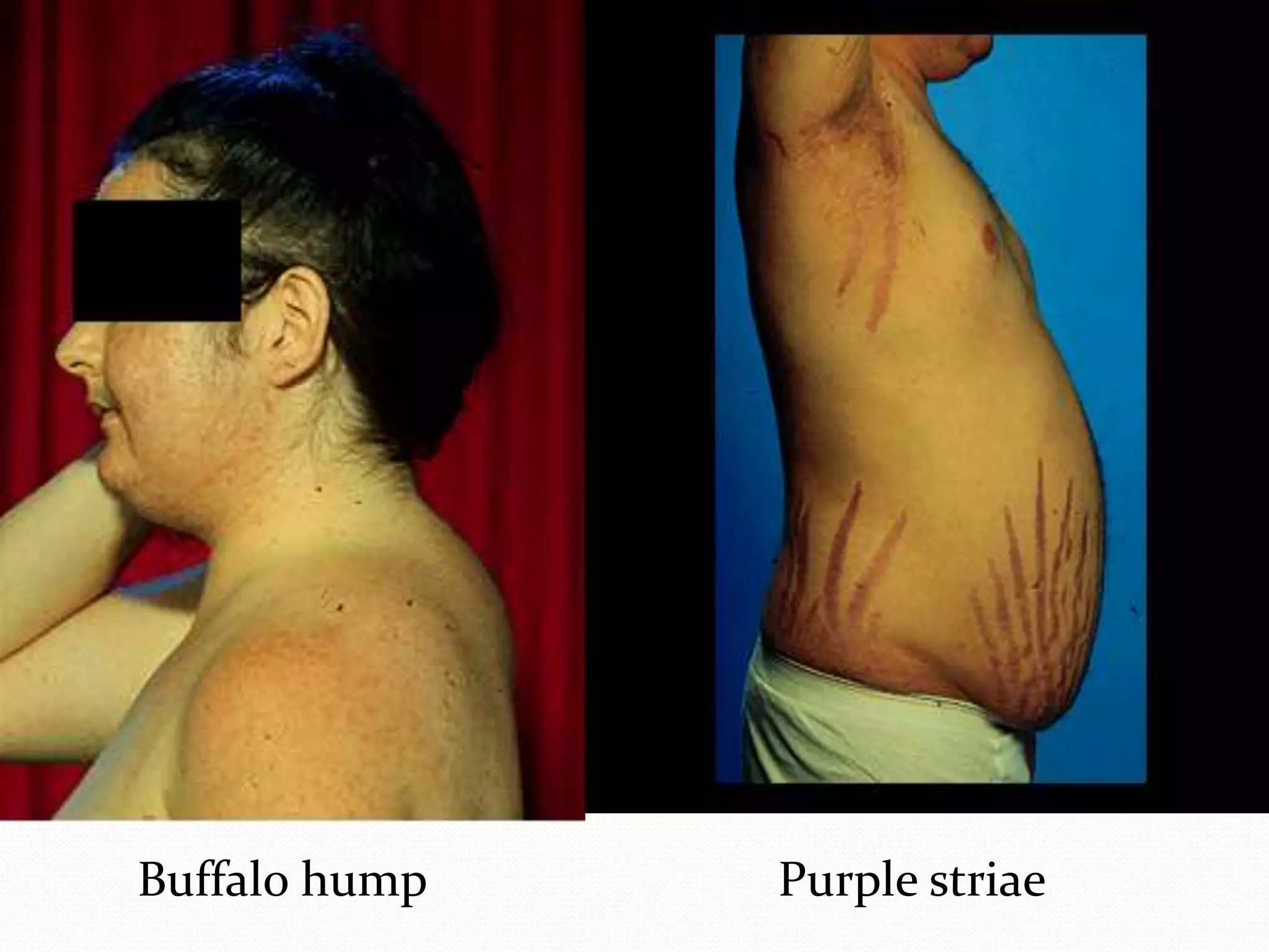 Buffalo hump Purple striae
 