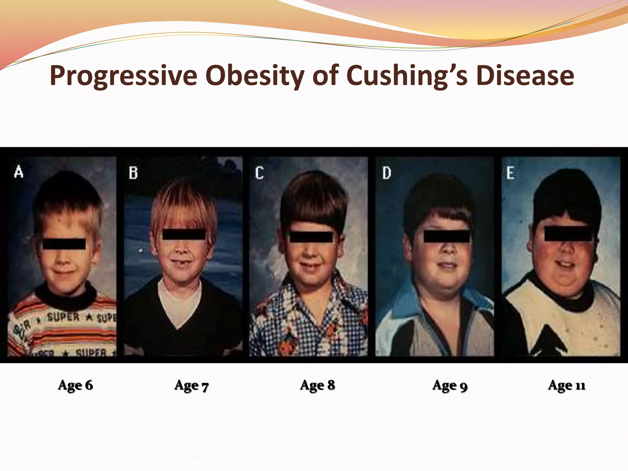 Progressive Obesity of Cushing’s Disease
William’s Textbook of Endocrinology. 8th Ed. Foster, DW, Wilson, JD (Eds), WB Saunders, Philadelphia, 1996
Age 6 Age 7 Age 8 Age 9 Age 11
 