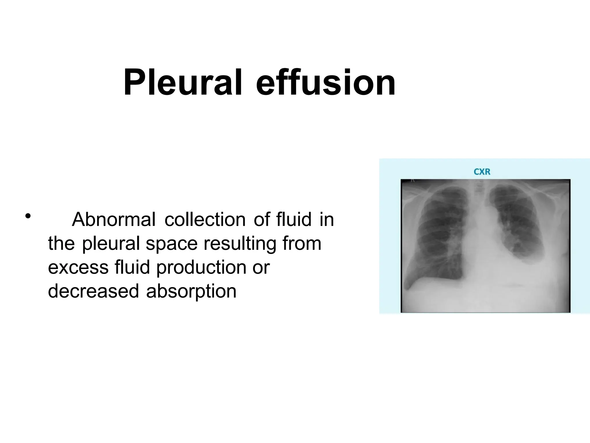 approach to pleural effusions 1 - Copy.pptx