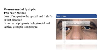 Vertical Distopia APPROACH TO PROPTOSIS.pptx..................... | PPTX