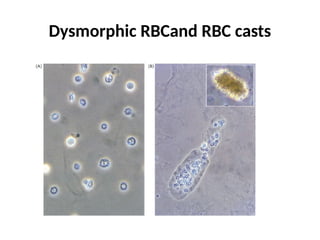 Disentagrating Rbc Cast APPROACH TO proteinuriaHEMATURIA (1).pptx