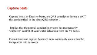 Approach to qrs wide complex tachycardias copy | PPTX
