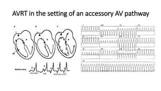 Approach to qrs wide complex tachycardias copy | PPTX