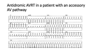 Approach to qrs wide complex tachycardias copy | PPTX
