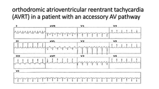 Approach to qrs wide complex tachycardias copy | PPTX