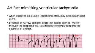 Approach to qrs wide complex tachycardias copy | PPTX