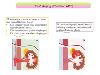 Approach to Renal cell carcinoma(RCC).pptx