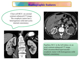 Approach to Renal cell carcinoma(RCC).pptx