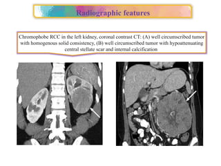 Approach to Renal cell carcinoma(RCC).pptx