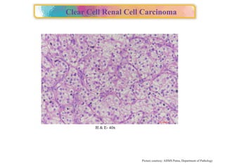 Approach to Renal cell carcinoma(RCC).pptx