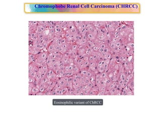 Approach to Renal cell carcinoma(RCC).pptx